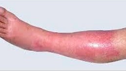 Erysipelas inflammation of the lower extremities 1
