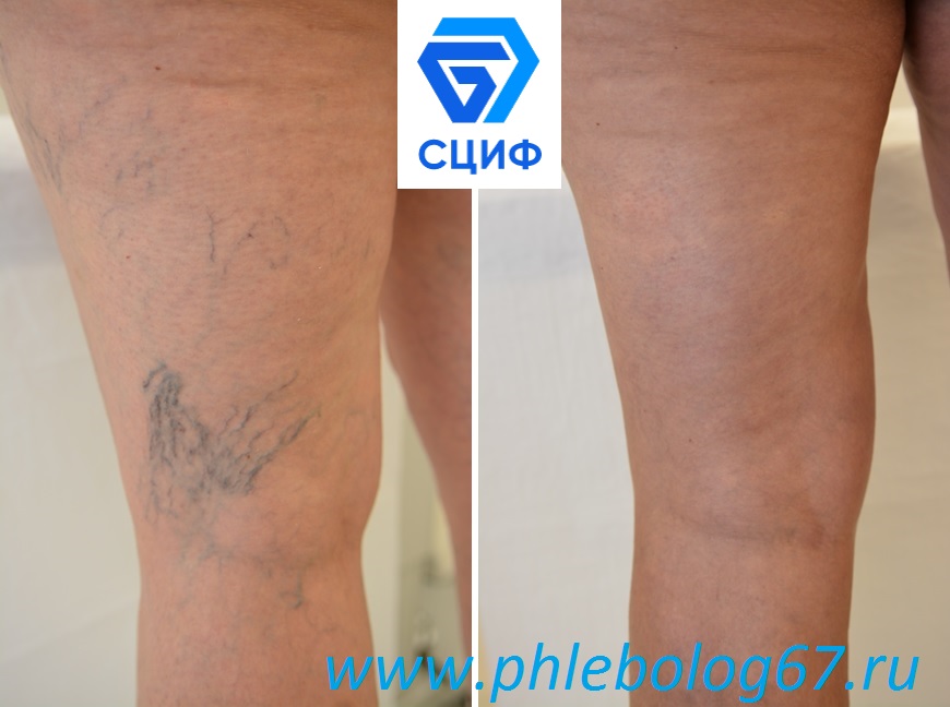 Microsclerotherapy of spiders veins
