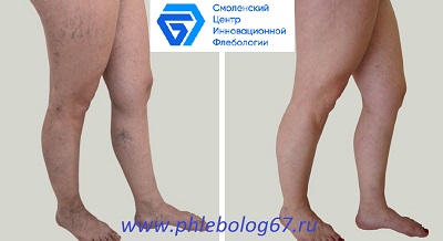 Фото до и после микросклеротерапии сосудистых звездочек на ногах