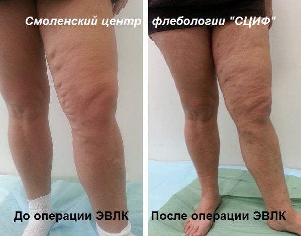 Фото до и после лечения лазером, без операции
